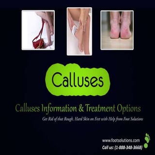 Calluses information & treatment