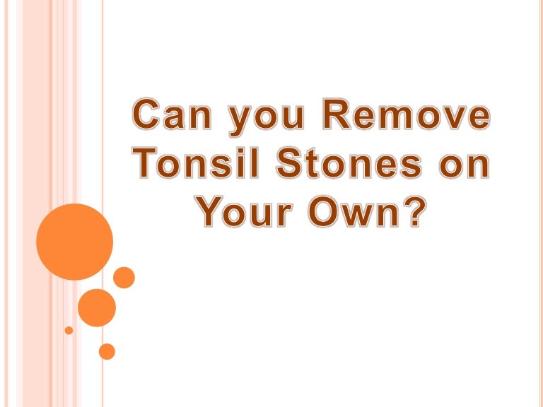 Can You Remove Tonsil Stones On Your Own