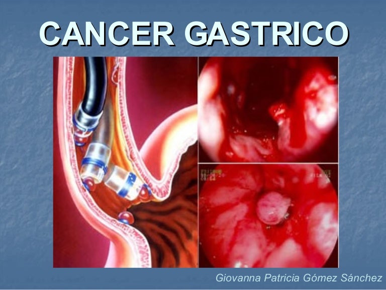 cancer de estomago 4 etapa