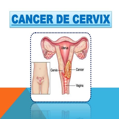 Cancer de cervix grethel garcia