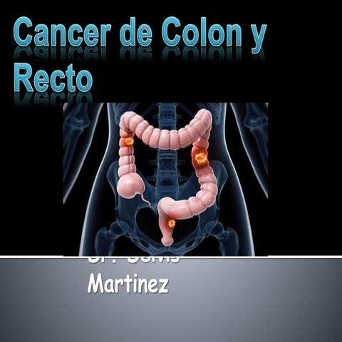Cáncer de colon | PPTX