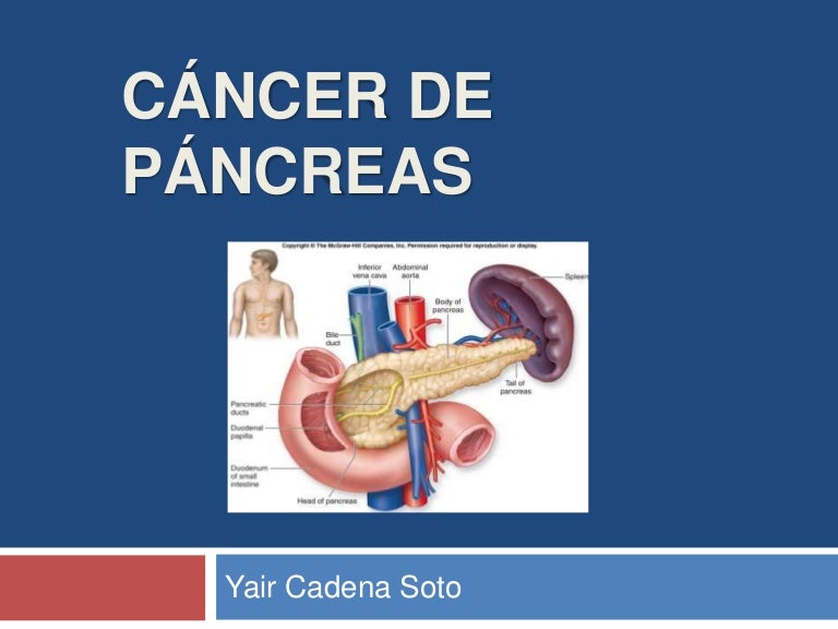 metástasis de cáncer de próstata a los ganglios linfáticos, síntomas de estómago y páncreas metástasis de cáncer de próstata a los ganglios linfáticos, síntomas de estómago y páncreas