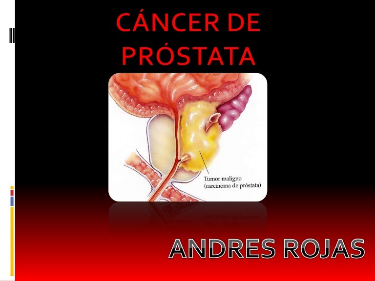 cancer de prostata estado 4
