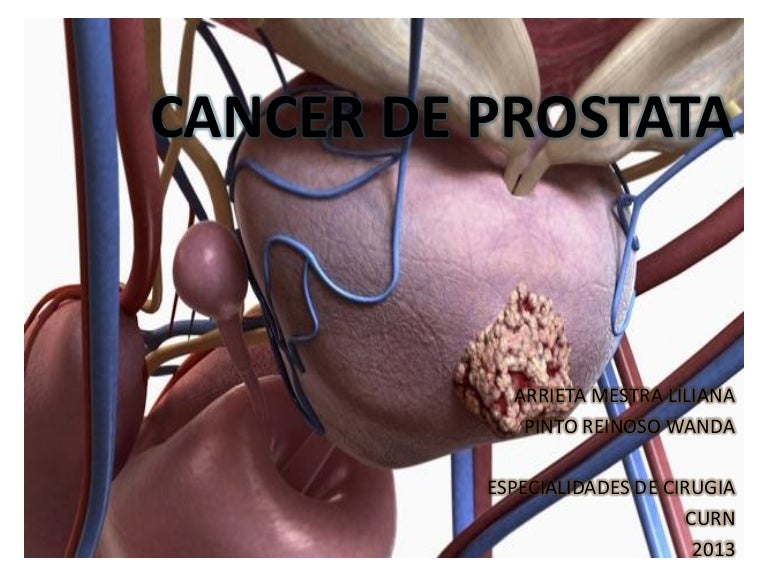 rehabilitación después de la terapia de protones para el cáncer de próstata