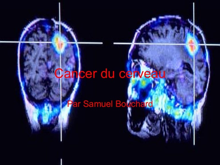 Cancer du cerveau