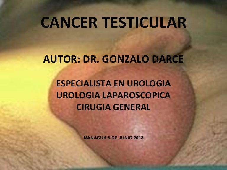 cancer de testiculo sintomas y tratamiento
