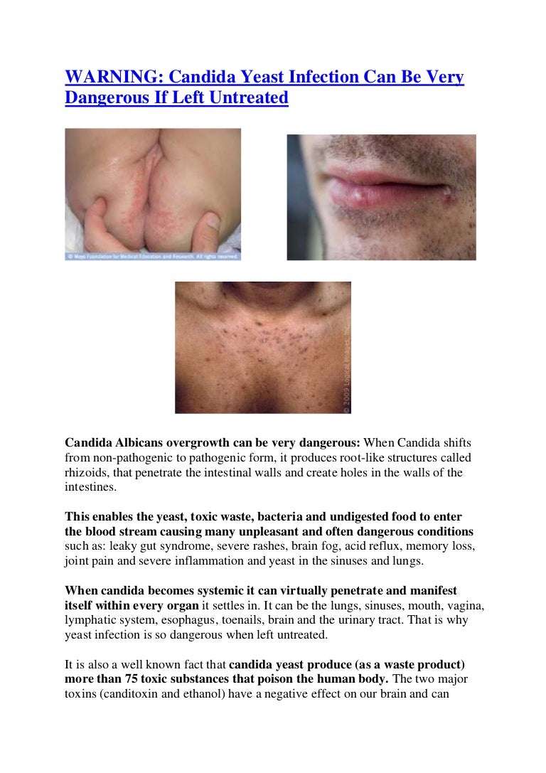 candidiasis in women
