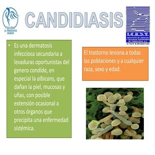 Candidiasis