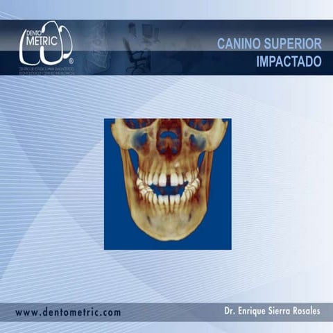 Canino superior impactado | PPTX