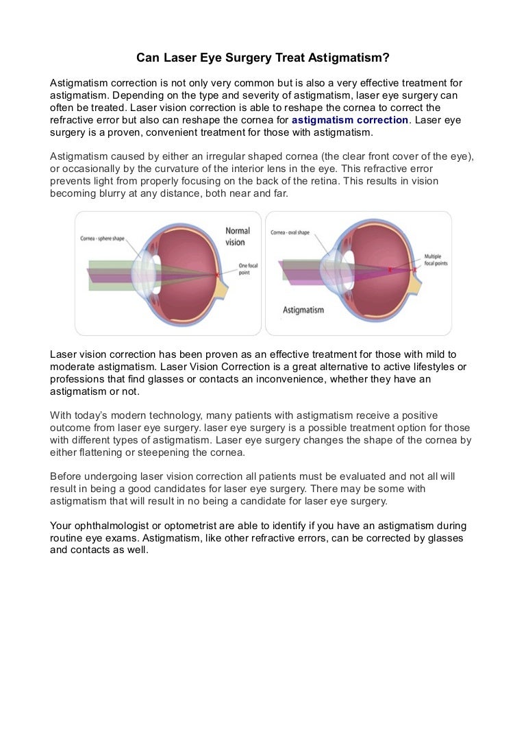 Astigmatism Correction Laser Eye Surgery Astigmatism