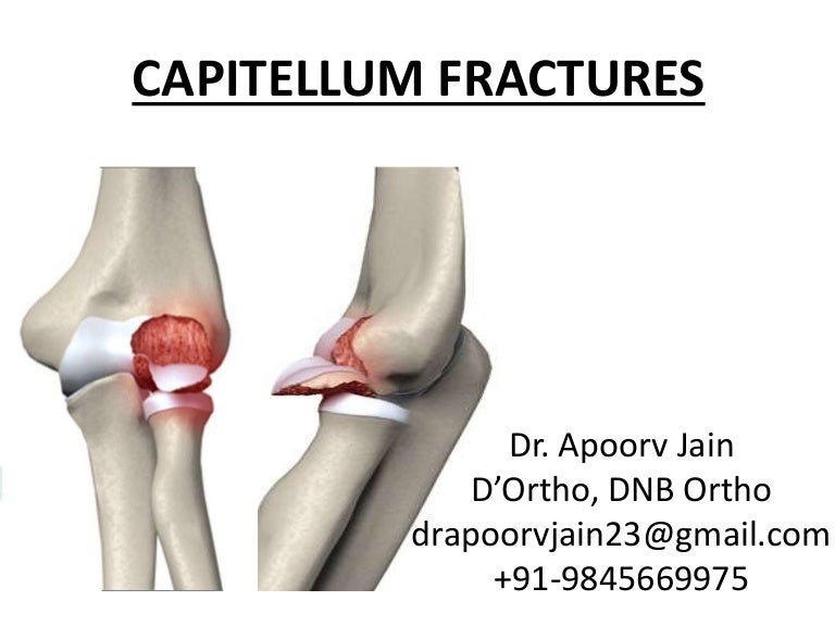 Capitellum fractures