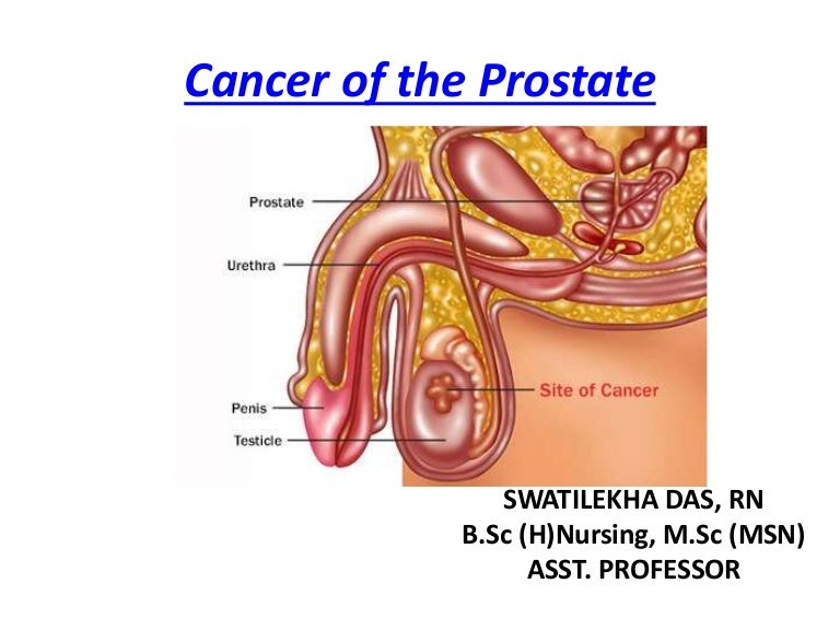 Cancer de prostată - Wikipedia, Prostate cancer genetic link