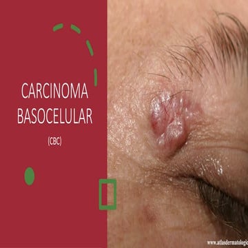 Comprehensive Overview of Basal Cell Carcinoma: Diagnosis, Variants ...