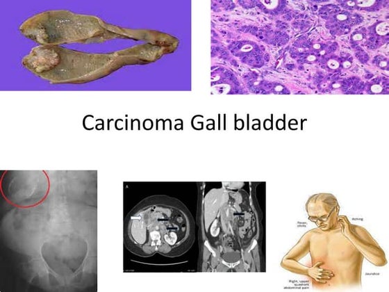 Carcinoma gallbladder. | PPT