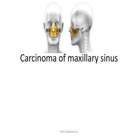 Carcinoma Maxillary sinus