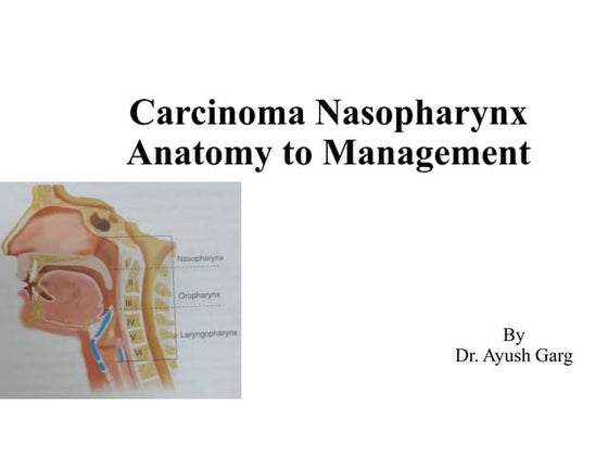 Nasopharyngeal carcinoma | PDF