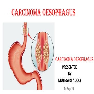 Carcinoma oesophagus. cancer of the eosophagus | PDF