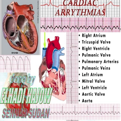 Cardiac arrhythmias