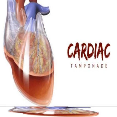 Cardiac tamponade 