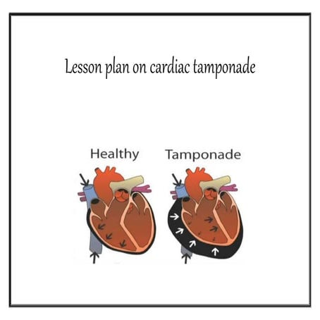 Cardiac tamponade lesson plan