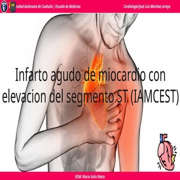 Infarto agudo al miocardio con elevacion del segmento ST | PPTX