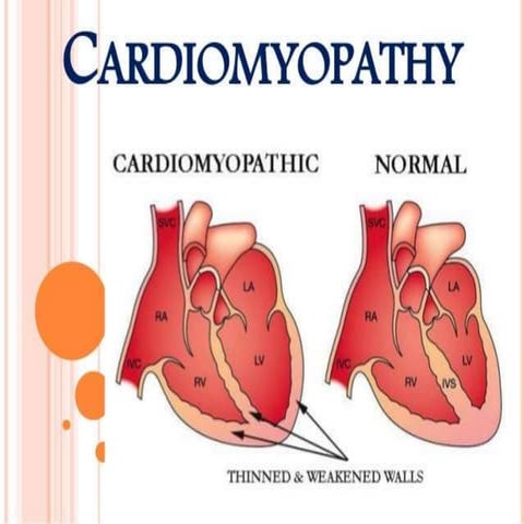 Cardiomyopathy om verma