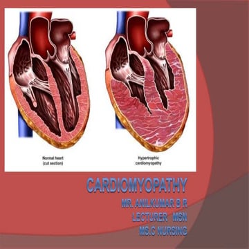 Cardiomyopathy 