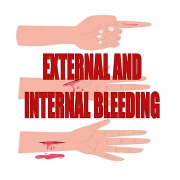 EXTERNAL AND INTERNAL BLEEDING. PPTX12890875