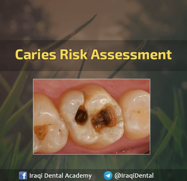 Cariology and caries risk assessment. by Dr.Kazhan O. abdulrahman.