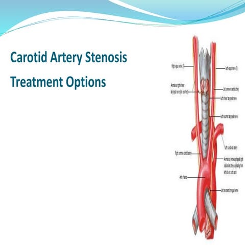 Carotid Artery Stenosis Treatment Options