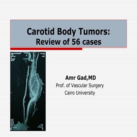 Carotid body tumors review of 56 cases | PPTX