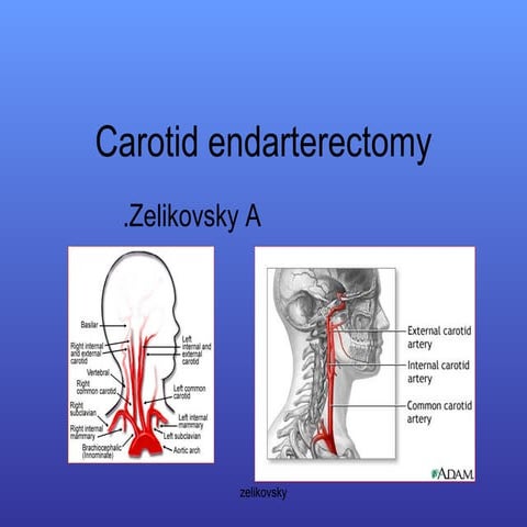 Carotid Endarterectomy | PPT