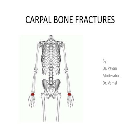 Carpal bone fractures