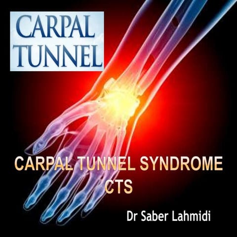 Carpal tunnel syndrome CTS 2014
