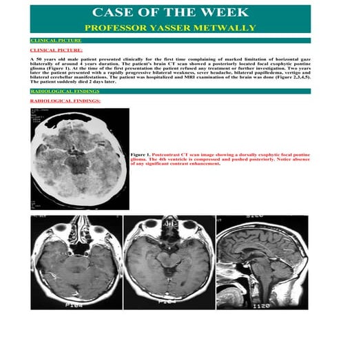 Case record...brain stem glioma