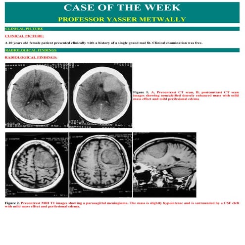 Case record...Parasagittal meningioma