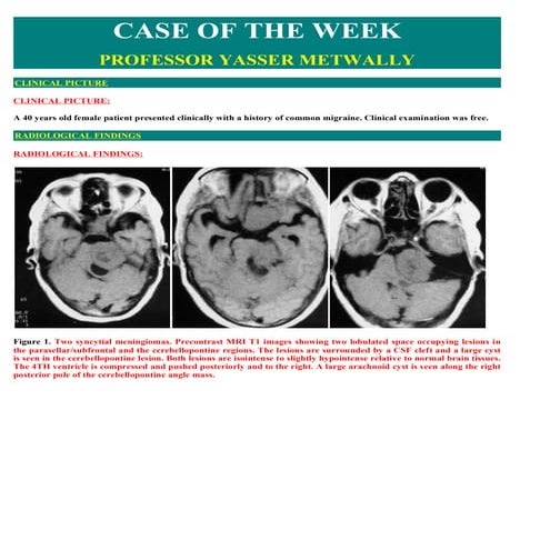 Case record...Multiple meningiomas