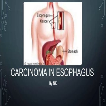 Esophageal Carcinoma