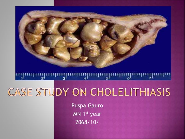 Clinical presentation of cholelithiasis image