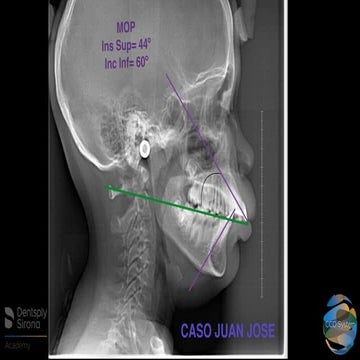 TRATAMIENTO DE ORTODONCIA CON SISTEMA CCO - DR. MAYA 