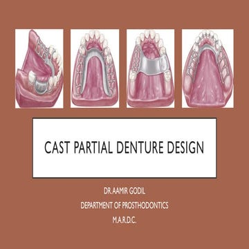 Cast partial denture design