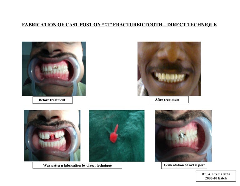 Cast post/cosmetic dentistry course by Indian dental academy