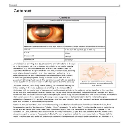 Cataract