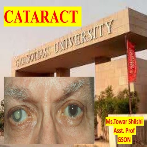Cataract