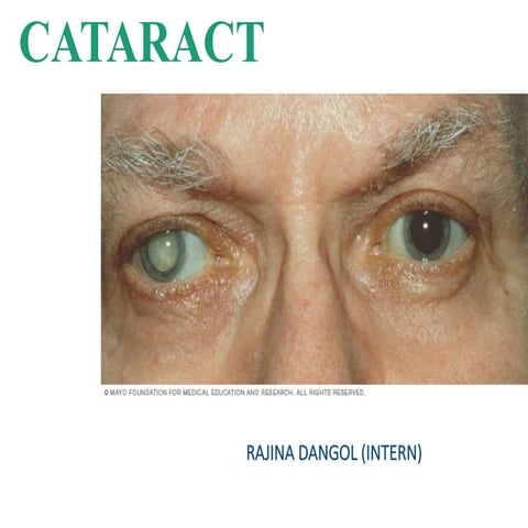 Cataract - Easy PPT for Nursing Students | PDF