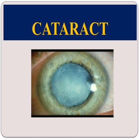Cataract and its management | PPTX