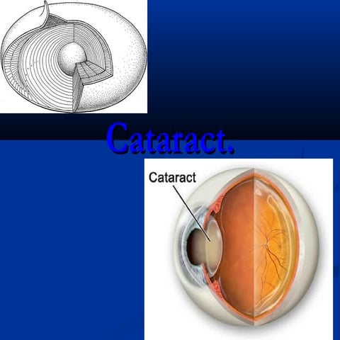 Cataract | PPTX