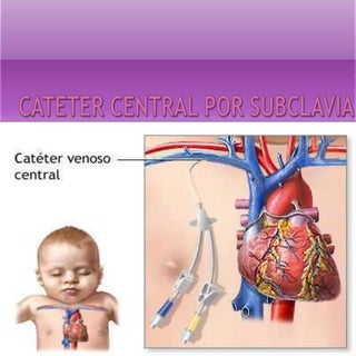 Cateter cerntral por subclavia