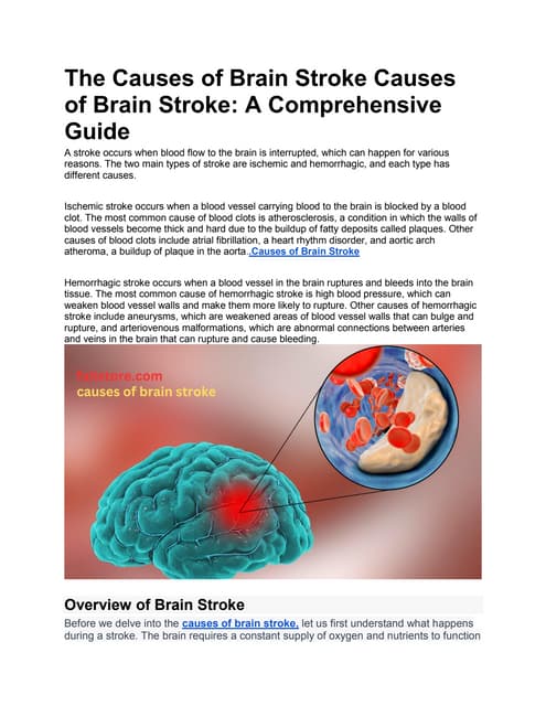 What are the Risk Factors of Brain Stroke? | PPT