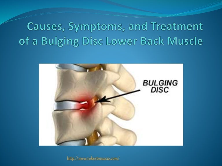 Causes, Symptoms, and Treatment of a Bulging Disc Lower Back Muscle